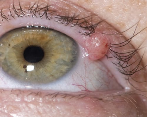 Common Eye Diseases